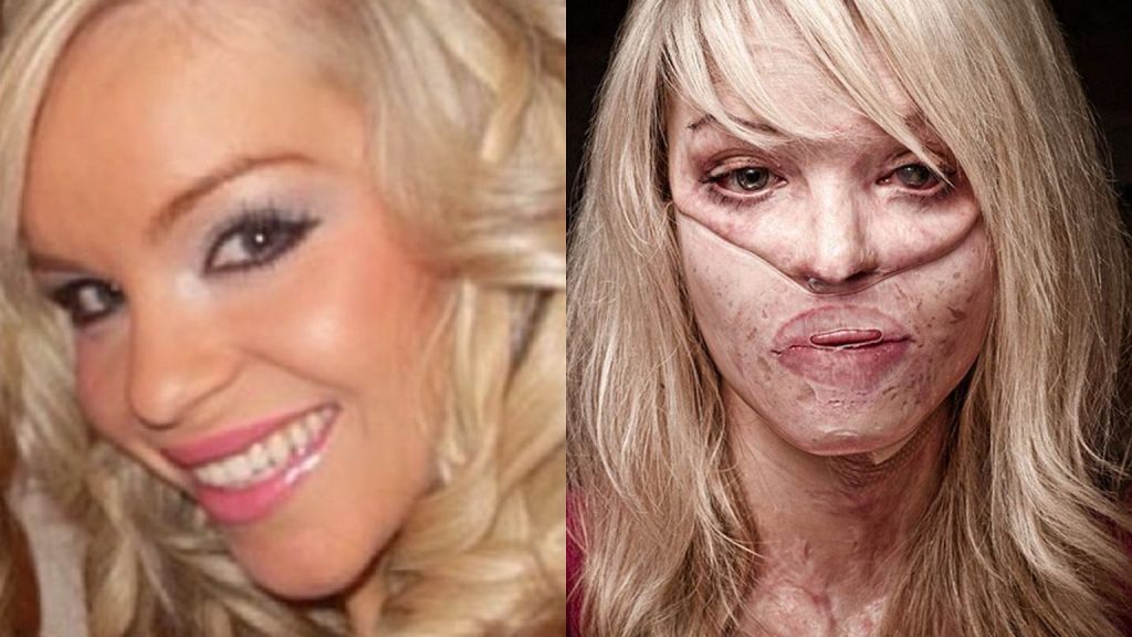 katie piper before and after acid attack
