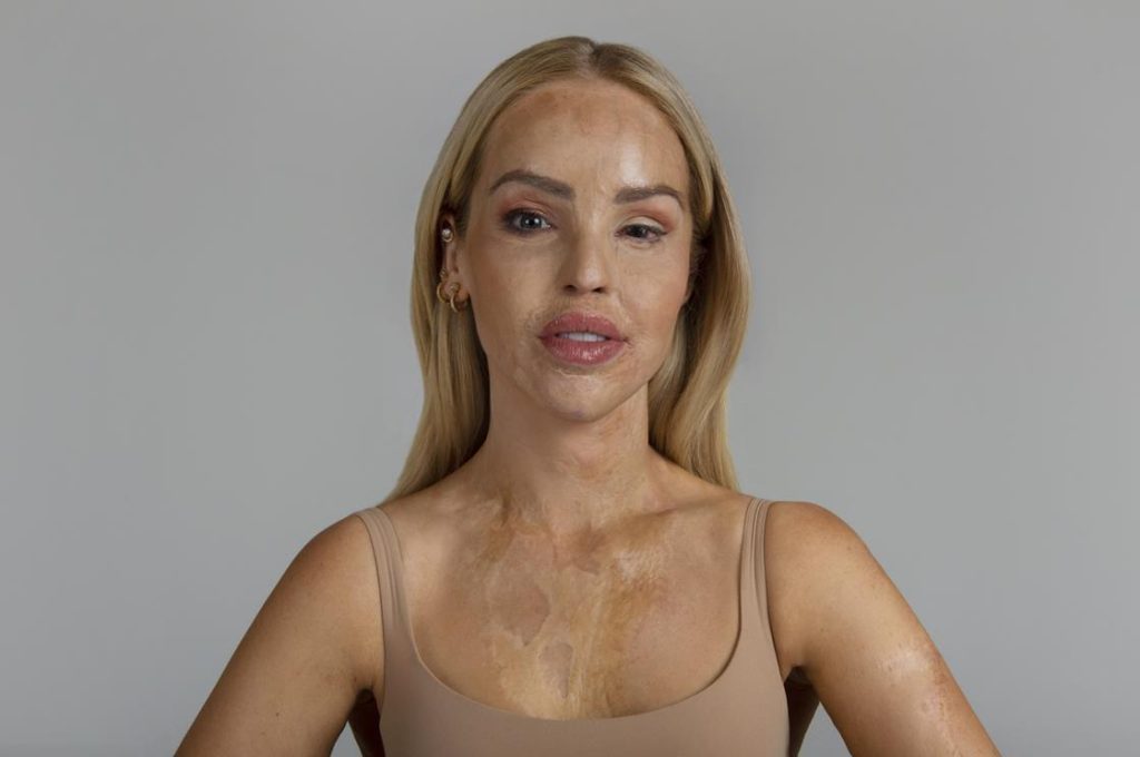 katie piper before and after acid attack